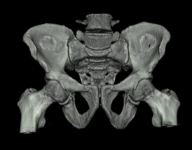 Dreidimensionale Oberflächenrekonstruktion eines Beckenskeletts aus einem hoch-aufgelösten Dünnschnitt-Datensatz einer normalen CT-Untersuchung