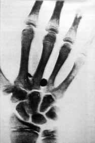 Aufnahme der Hand eines 16jährigen Patienten vom 29. Mai 1896 in Basel